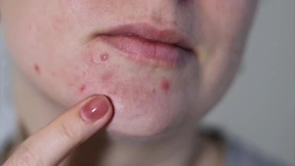 Detail ženské tváře s červenou problematickou akné kůže, rozmazané pozadí  - Záběry, video