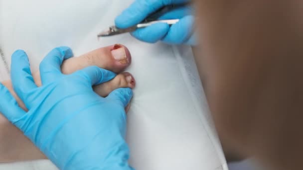 Podolog v modrých gumových rukavicích stříhá nehty s bradavkami na ženském palci na klinice - Záběry, video