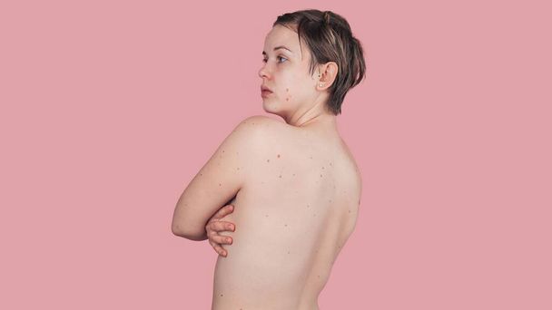 Ciało kobiety z licznymi pieprzykami. Zapobieganie rakowi skóry. Panoramę. Miejsce na tekst - Zdjęcie, obraz