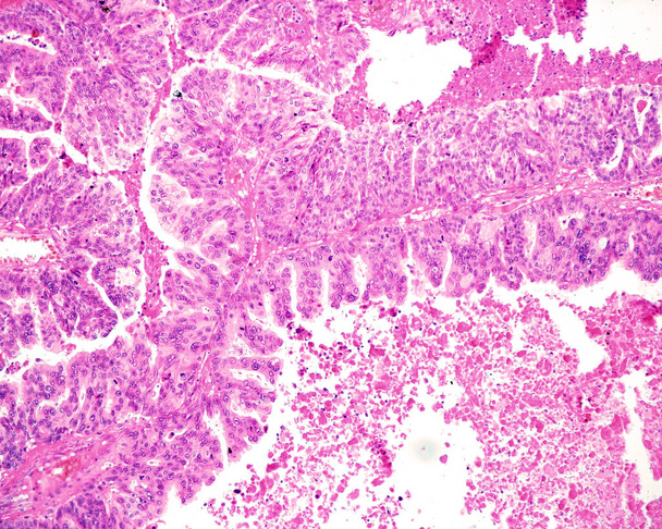 過剰卵巣がんは,上皮卵巣がんの最も一般的なタイプである. 高等血清がんは,すべてのエピセル卵巣がんの75%を占めています. 歴史的には,このパターンはペピラリーや固体成長パターンとは異なる. タンゴー は - 写真・画像