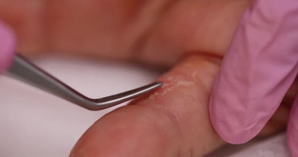 El médico extrae la piel del dedo del paciente. Peeling y psoriasis de la piel de las manos - Metraje, vídeo