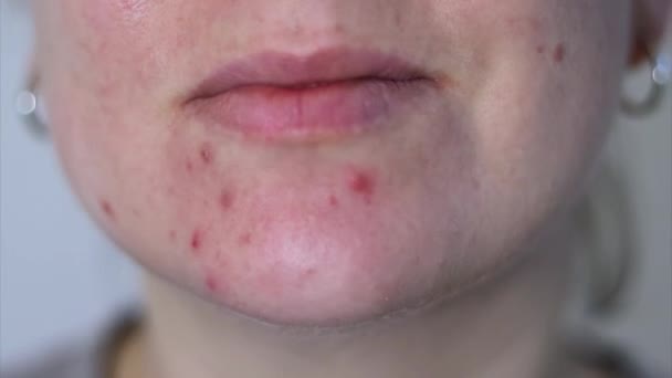 Fechar o rosto feminino com pele de acne problemática vermelha, fundo embaçado  - Filmagem, Vídeo