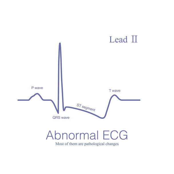 Anormal EKG depolarizasyon dalgaları ve kutuplaşma dalgaları anlamına gelir, bunların çoğu patolojik ve çok azı fizyolojik. - Fotoğraf, Görsel