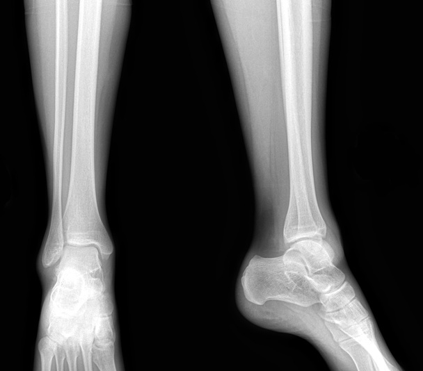 Gerçek röntgen sağlıklı alt bacak - ön ve yan görünüm - Fotoğraf, Görsel