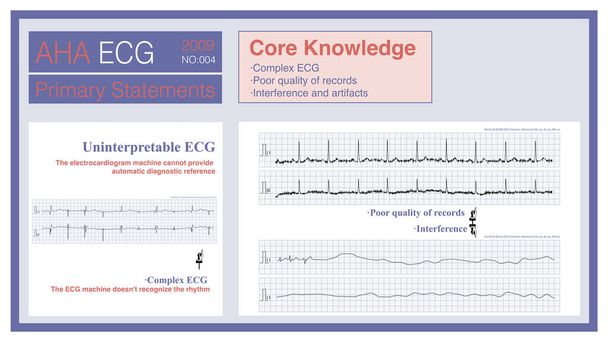 ECG çok karmaşık olduğunda, kayıt kalitesi düşüktür, ya da ECG 'nin kaybına neyin sebep olduğunu yorumlamak imkansızdır, ECG makinesi tanısal bir referans sağlayamaz.. - Fotoğraf, Görsel
