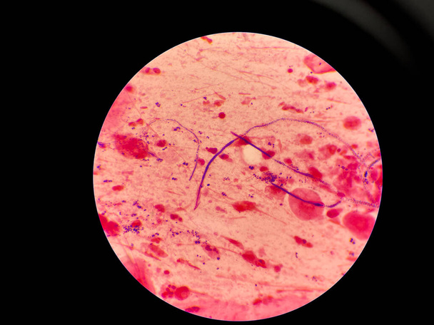 Μήτρες και εκκολαπτόμενα κύτταρα ζύμης σε λεκέ πτυέλων gram. - Φωτογραφία, εικόνα