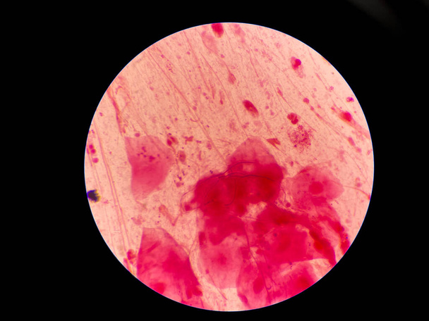 Mold and budding yeast cell in sputum gram stain. - Photo, Image