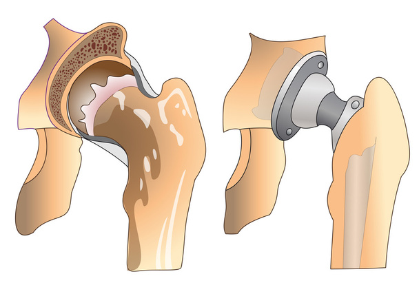 Hip prosthesis - Vector, Image