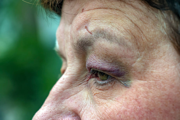 Ein menschliches Auge mit einer großen schwarz-violetten Prellung. Schwellung durch Blutergüsse. - Foto, Bild