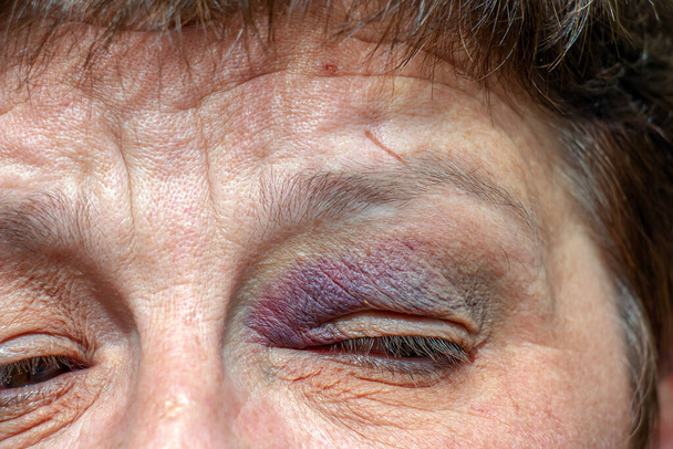 Ein menschliches Auge mit einer großen schwarz-violetten Prellung. Schwellung durch Blutergüsse. - Foto, Bild