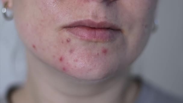Primer plano de la cara femenina con piel de acné problemático rojo, fondo borroso  - Metraje, vídeo