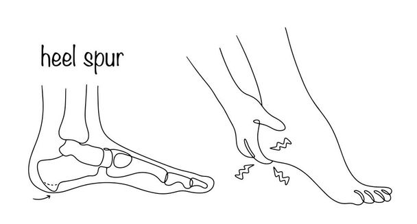 Шпора каблука. Костный рост, который имеет форму шипа в области пятки. Боль в ноге из-за наличия пятки шпоры. Векторная иллюстрация. - Вектор,изображение