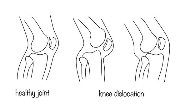 Zdravé vykloubení kolene a kolena. Vytěsnění stehenní kosti. Lékařská ilustrace. Lidská anatomie. - Vektor, obrázek
