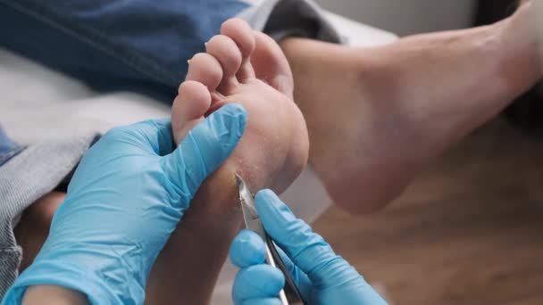 Un podologue utilisant des tondeuses enlève un cal d'un pied de femme au centre médical. - Séquence, vidéo