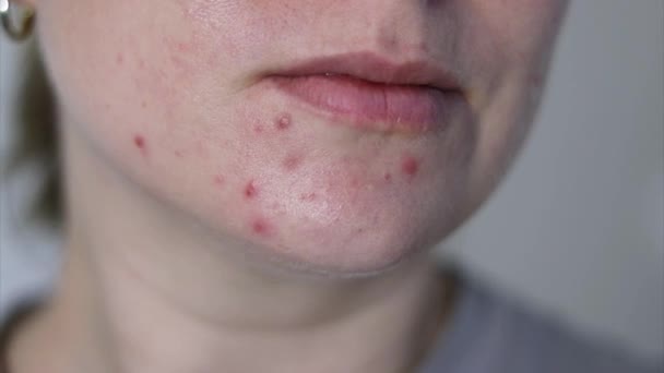 Gros plan du visage féminin avec une peau rouge problématique d'acné, fond flou  - Séquence, vidéo