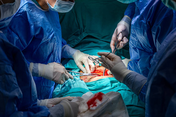 Surgeons performing cesarean section in operating room. Birth surgery with Caesarean. New life, baby being born via Caesarean Section in the operating room (mature content). - Photo, Image