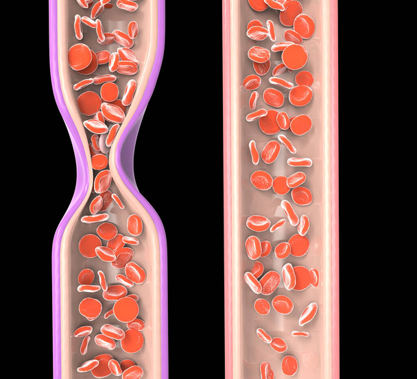 Blokovaná žíla v důsledku trombózy a normální žíly s krvinkami. 3D vykreslování - Fotografie, Obrázek
