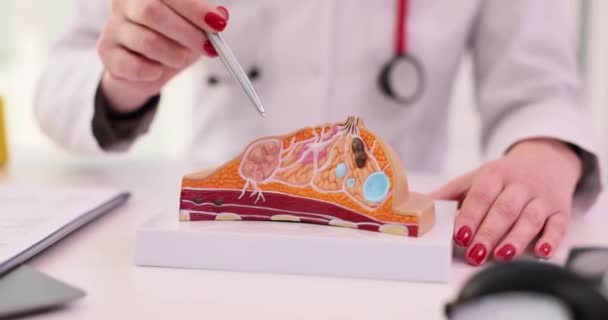 Medico femminile spiega la malattia utilizzando un modello anatomico del seno. Diagnosi di malattie mammologiche - Filmati, video