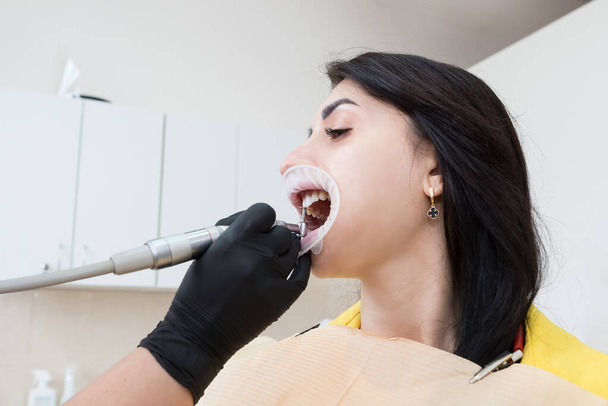 Der Zahnarzt setzt dem Patienten Veneers auf. Der Installationsprozess. Zahnheilkunde, Smile Design, Weiße Zähne. Wiederherstellung der Zähne. - Foto, Bild