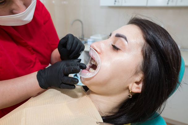 歯科医は患者に歯科用ベニヤを入れています. インストールのプロセス.歯科,スマイルデザイン,ホワイト歯.歯の修復. - 写真・画像