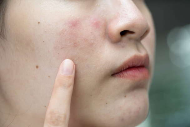 Asiatique jeune avec bouton, acné, cicatrice sur la peau, problème facial. - Photo, image
