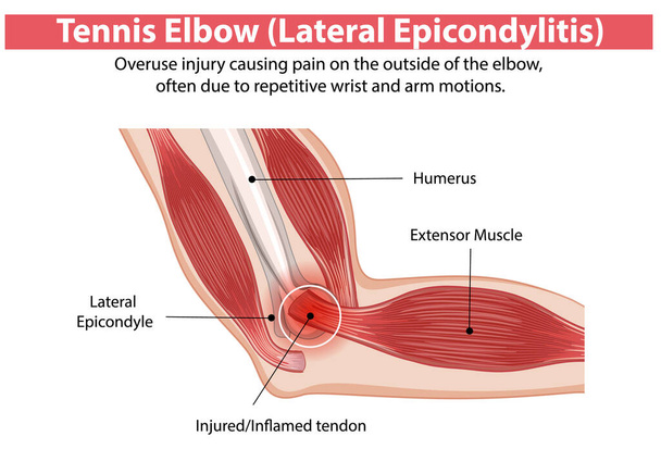 Εικονογράφηση του τραυματισμού αγκώνα τένις και πληγείσες περιοχές - Διάνυσμα, εικόνα