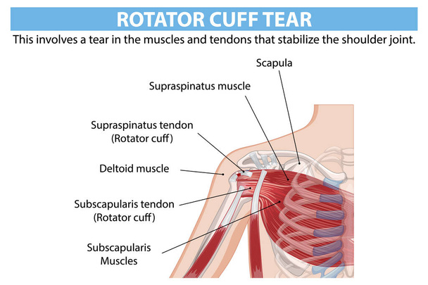 Anatomía detallada del desgarro del manguito rotador del hombro - Vector, imagen
