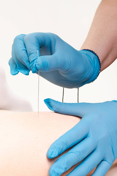Um close-up detalhado de várias agulhas de acupuntura inseridas na perna de uma pessoa, destacando práticas de medicina alternativa - Foto, Imagem