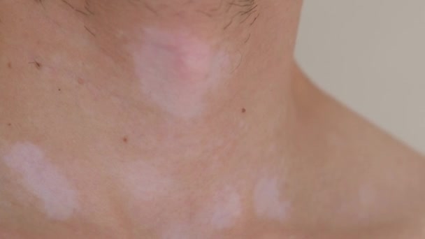 emberi bőr vitiligóval közelről. Kiváló minőségű 4k felvételek - Felvétel, videó