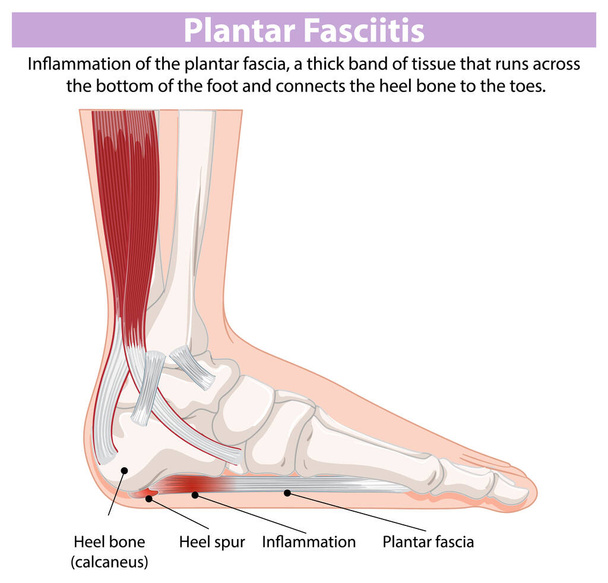 Diagrama detallado de la inflamación del pie - Vector, imagen
