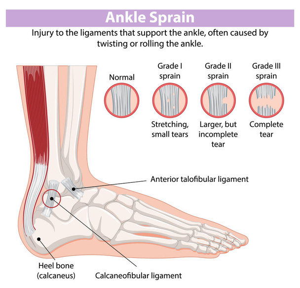 Detailed diagram of ankle sprain types - Vector, Image