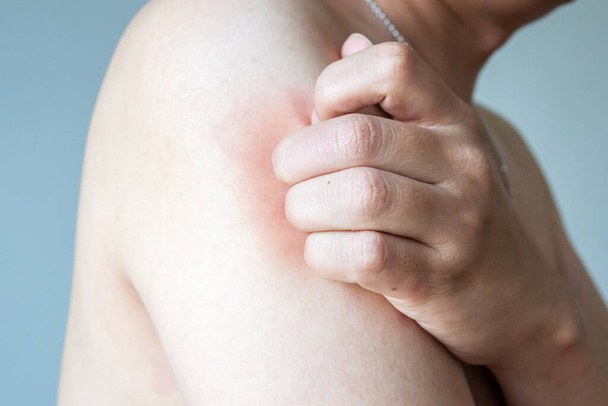 Junger asiatischer Mann juckt und kratzt am Arm von allergischem Juckreiz trockener Haut Ekzem Dermatitis Insektenstiche - Foto, Bild