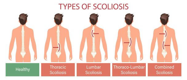 Tipos de escoliosis, enfermedad espinal. Banner de infografías con columna vertebral para escoliosis humana. Salud y medicina. Ilustración, póster - Vector, imagen