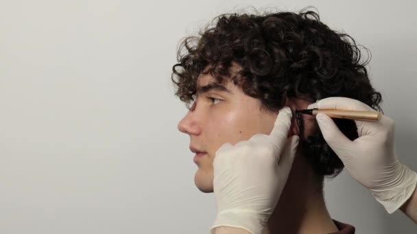 4kビデオ 耳にオトパシーのマークアップを作る. 外科医は耳の外科医の前にマークアップラインを描きます. 耳の形状を修正するために耳のピンナにマークアップを適用する - 映像、動画