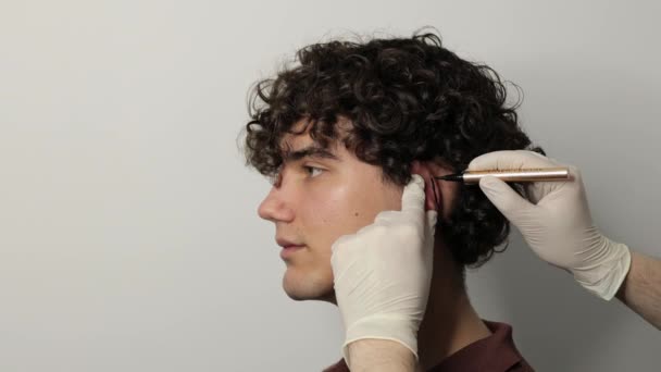 4k βίντεο εφαρμογή markup στο αυτί pinna να διορθώσει το σχήμα των αυτιών. Οτοπλαστική μάρκα στο αυτί. Χειρουργός σχεδιάζει γραμμές σήμανσης πριν από Otoplasty χειρουργός στα αυτιά - Πλάνα, βίντεο