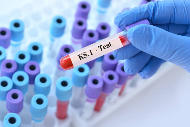 Médico sosteniendo un tubo de muestra de sangre de prueba para la detección del virus KS.1 en el fondo de los tubos de ensayo médicos. KS.1 una de las variantes de FliRT. Los síntomas con FLiRT son los mismos que con el omicrón - Foto, imagen
