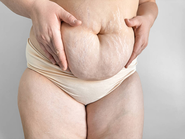 Lähikuva synnytyksen vatsa venyttää markkaa, edistää kehon positiivisuutta ja todellisuutta äitiyden. Laadukas kuva - Valokuva, kuva