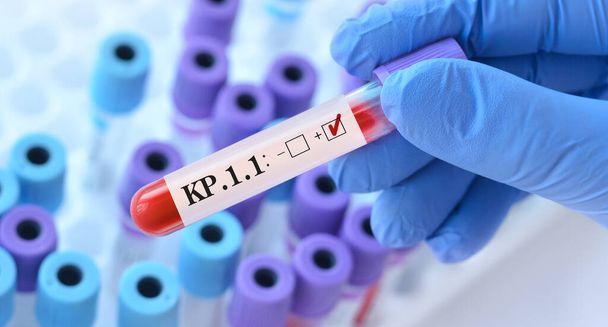 Doctor holding a test blood sample tube for the detection of the virus KP.1.1 on the background of medical test tubes. KP.1.1 , one of the FliRT variants. Symptoms with FLiRT are the same as with omicron - Photo, Image