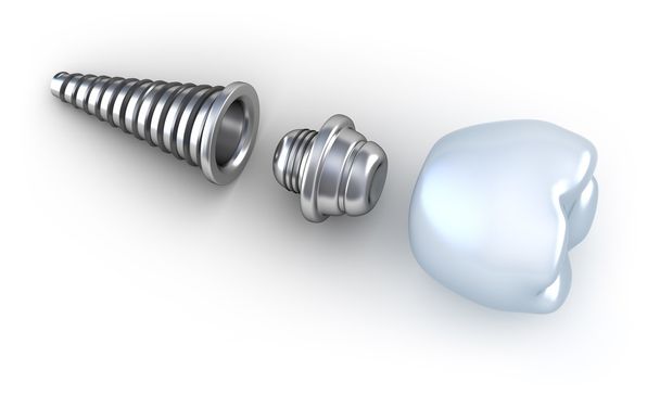 Dental implant 3d crown - Фото, изображение