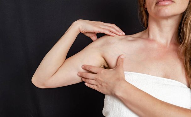 Bir kadının omzunda ameliyat sonrası yara izi. Kırık bir kol kemiğinden sonra ameliyat sonrası iyileşen yara. - Fotoğraf, Görsel