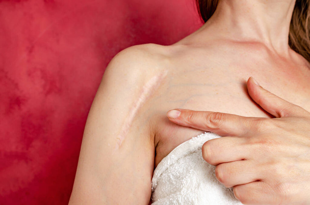 Післяопераційний шрам на жіночому плечі. Жінка показує шрам. Шрам після операції після розбитої кістки руки. - Фото, зображення