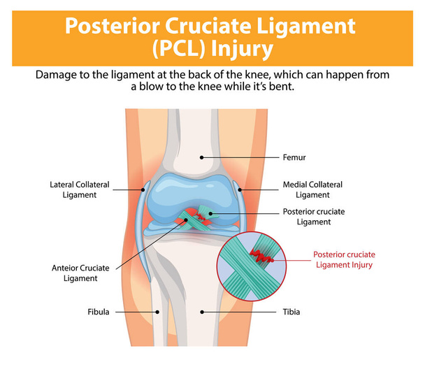 Ilustración de lesión por LCP en la articulación de la rodilla - Vector, Imagen