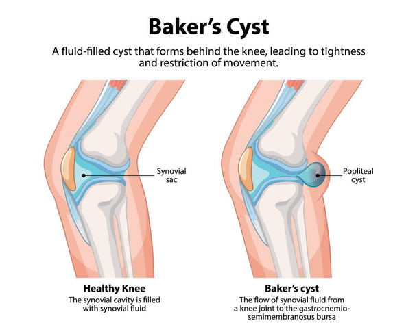 Comparación de rodilla sana y quiste de Baker - Vector, Imagen