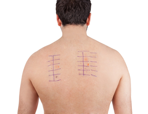 Kožní alergie Patch Test na Bacck - Fotografie, Obrázek