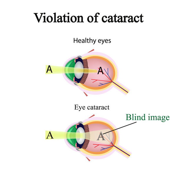 La estructura del ojo. Cataratas. Como el ojo afectado ve cataratas. Violación de cataratas
 - Vector, Imagen