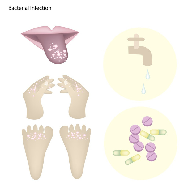 Infecção bacteriana com prevenção e tratamento de doenças
 - Vetor, Imagem