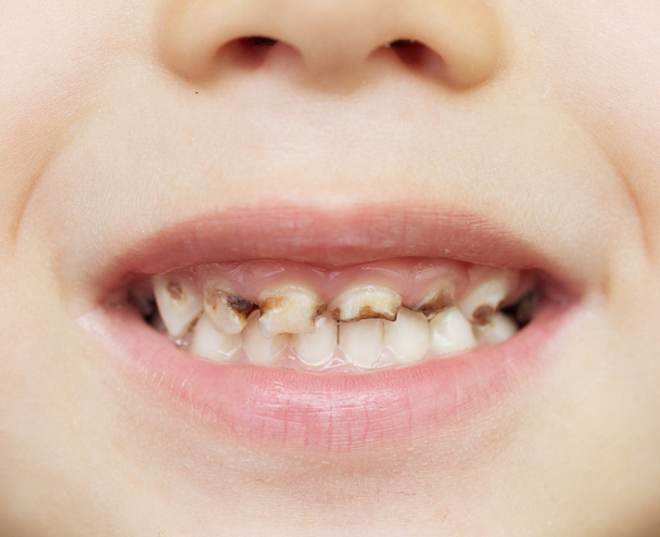 Denti cattivi
 - Foto, immagini