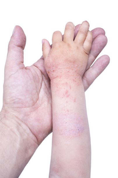 Eczema sulla mano del bambino
 - Foto, immagini