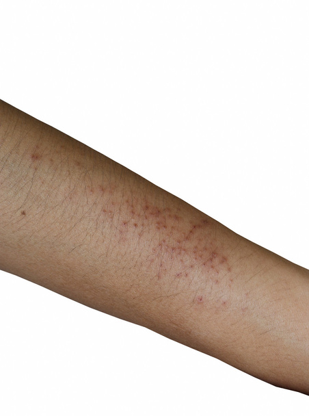rash on arm isolated on white background - Photo, Image