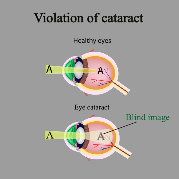 La estructura del ojo. Cataratas. Como el ojo afectado ve cataratas. Violación de cataratas
 - Vector, Imagen